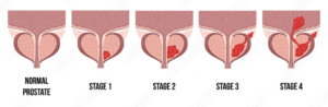 Stages of Prostate Cancer