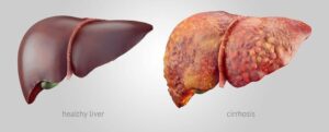 Liver Cancer