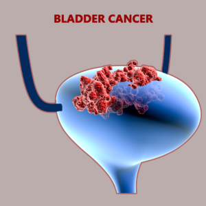 bladder cancer