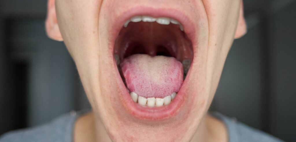 Spot Early Signs of Oral Cancer