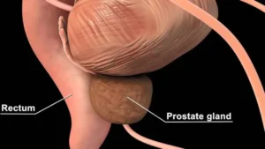 Prostate Cancer Treatment