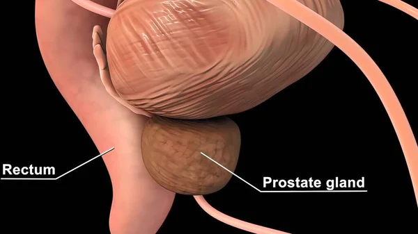 Prostate Cancer Treatment
