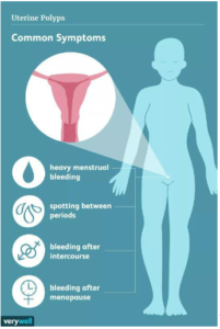 uterine polyps