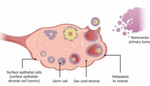 Ovarian Cancer Cells