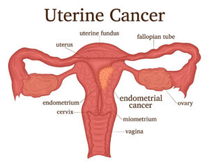 Uterine Cancer