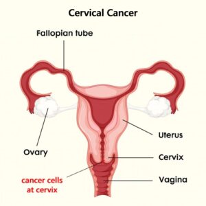 cervical cancer cells