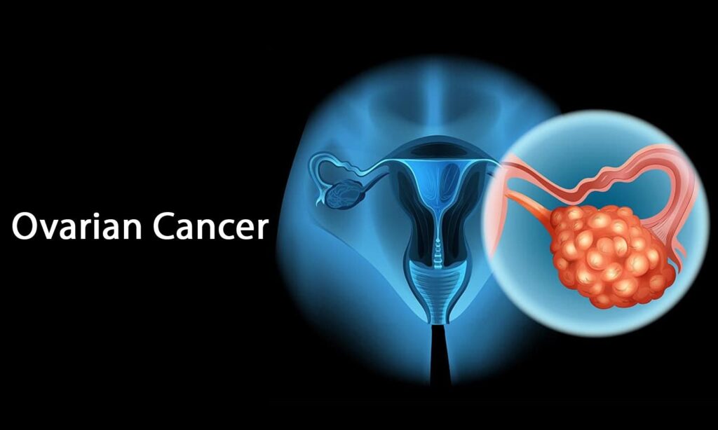 ovarian cancer