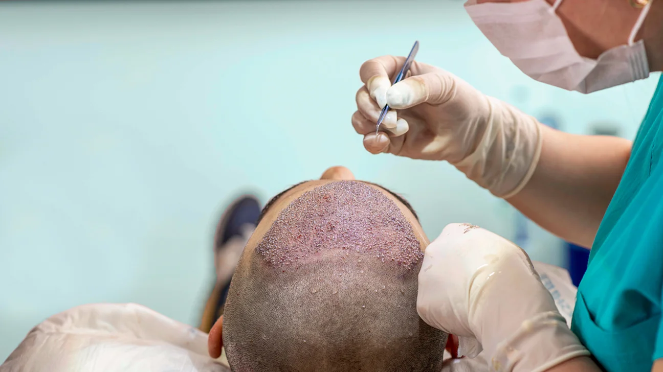 Hair Transplant Cause Cancer