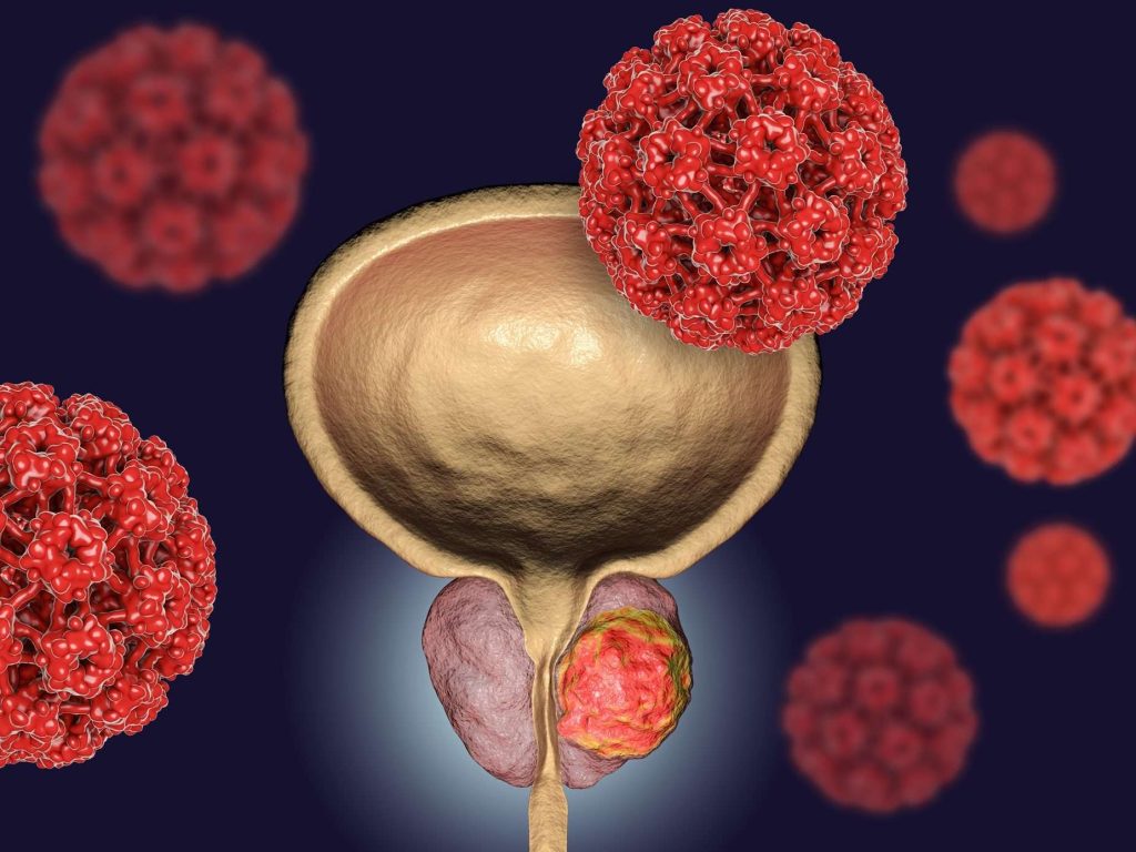 GettyImages 872565754 prostaatkanker e1606234094879