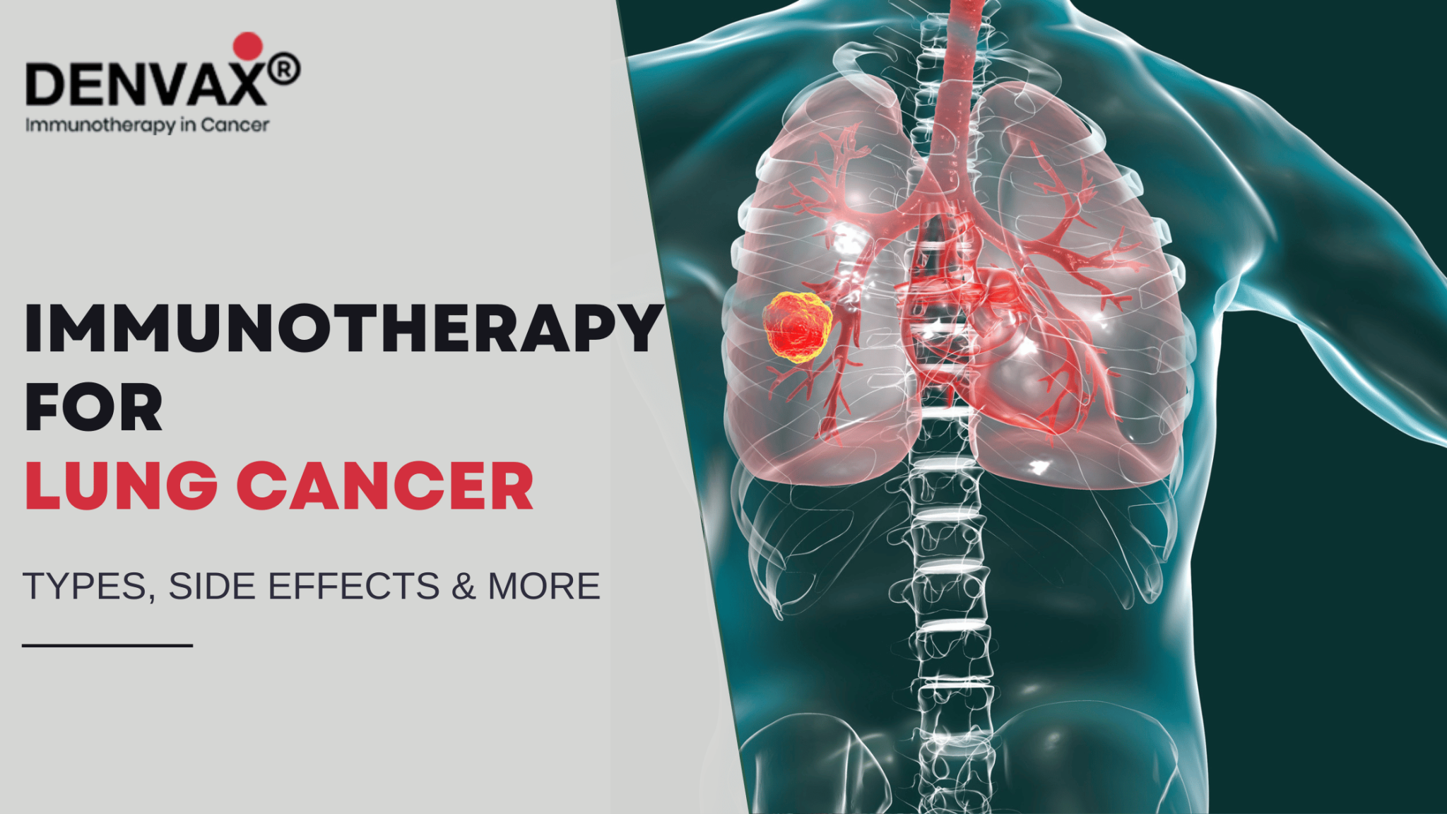 Immunotherapy for Lung Cancer: Types, Side Effects & More - Denvax
