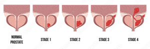 Stages of Prostate Cancer