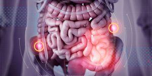 Bowel Cancer Treatment