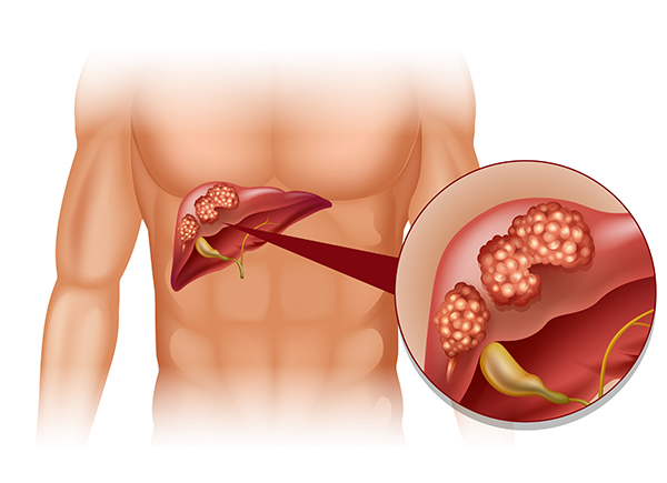 Liver Cancer Treatment