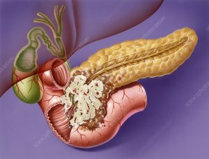 M1310741 Pancreatic cancer artwork