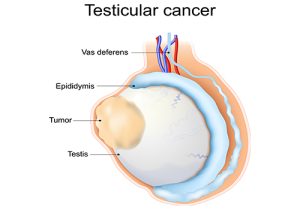 Testicular-Cancer