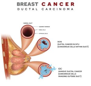 Breast Cancer
