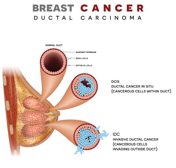 Breast Cancer
