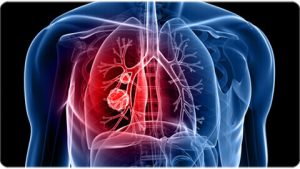 Lung Cancer Specialist