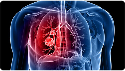 Lung Cancer Specialist