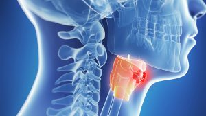 Symptoms of Throat Cancer