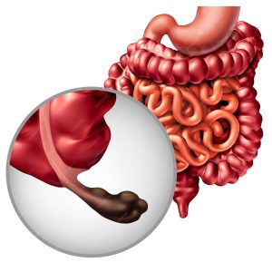 appendix cancer intestine disease gastrointestnal digestion with malignant tumor symptoms 924455 138