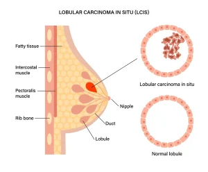 lobular carcinoma situ normal lobule 600nw 1857296347