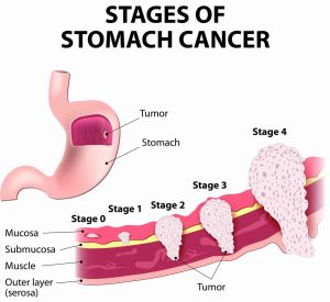 stomach cancer