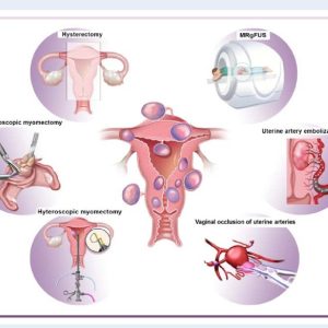 Current surgical and non surgical management strategies of myomas Left panel Q640
