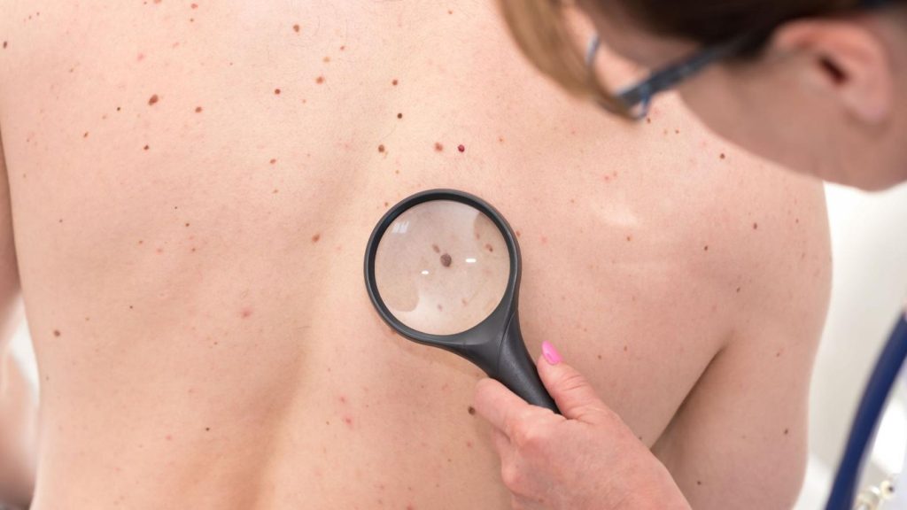 Early Signs of Cancer