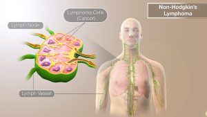 Medical Animation Still Shot Showing Non Hodgkins Lymphoma