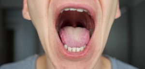 Spot Early Signs of Oral Cancer