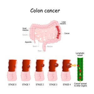 stages of colon cancer