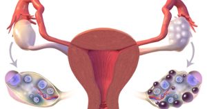 tenho cistos nos dois ovarios e possivel eu engravidar og