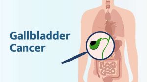 Gallbladder Cancer Symptoms