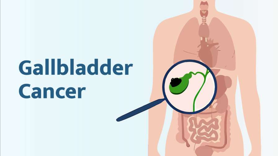 Gallbladder Cancer Symptoms