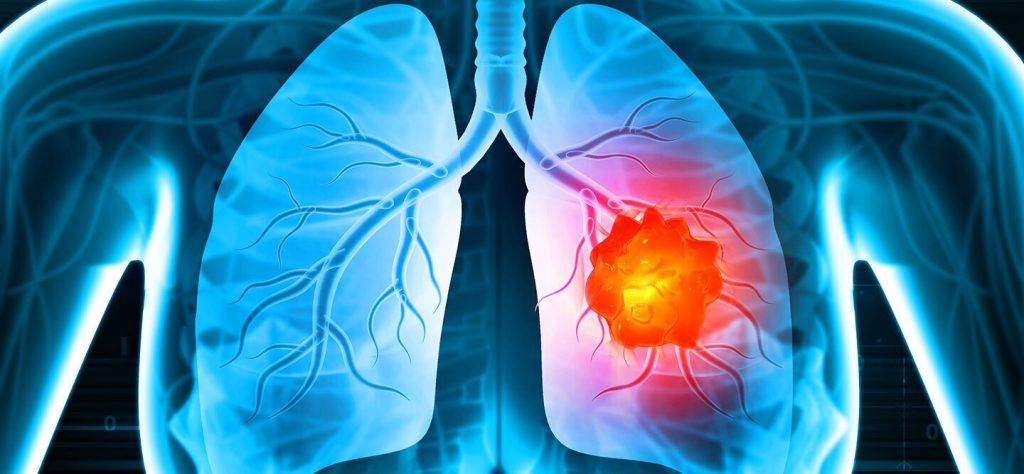 Best Lung Cancer Treatment in India