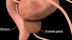 Prostate Cancer Treatment