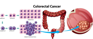 Colorectal Cancer Cells