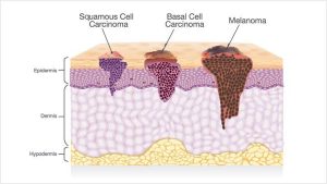 skin cancer cells