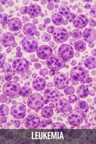 Leukemia Immunotherapy Treatment