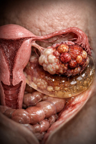 Ovarian Cancer Immunotherapy Treatment